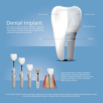 Human teeth and dental implant template Free Vector