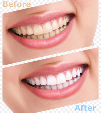 Tooth whitening Human tooth Cosmetic dentistry - Comparison of cleaning teeth 