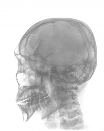 A schedel AP radiograph of the skull